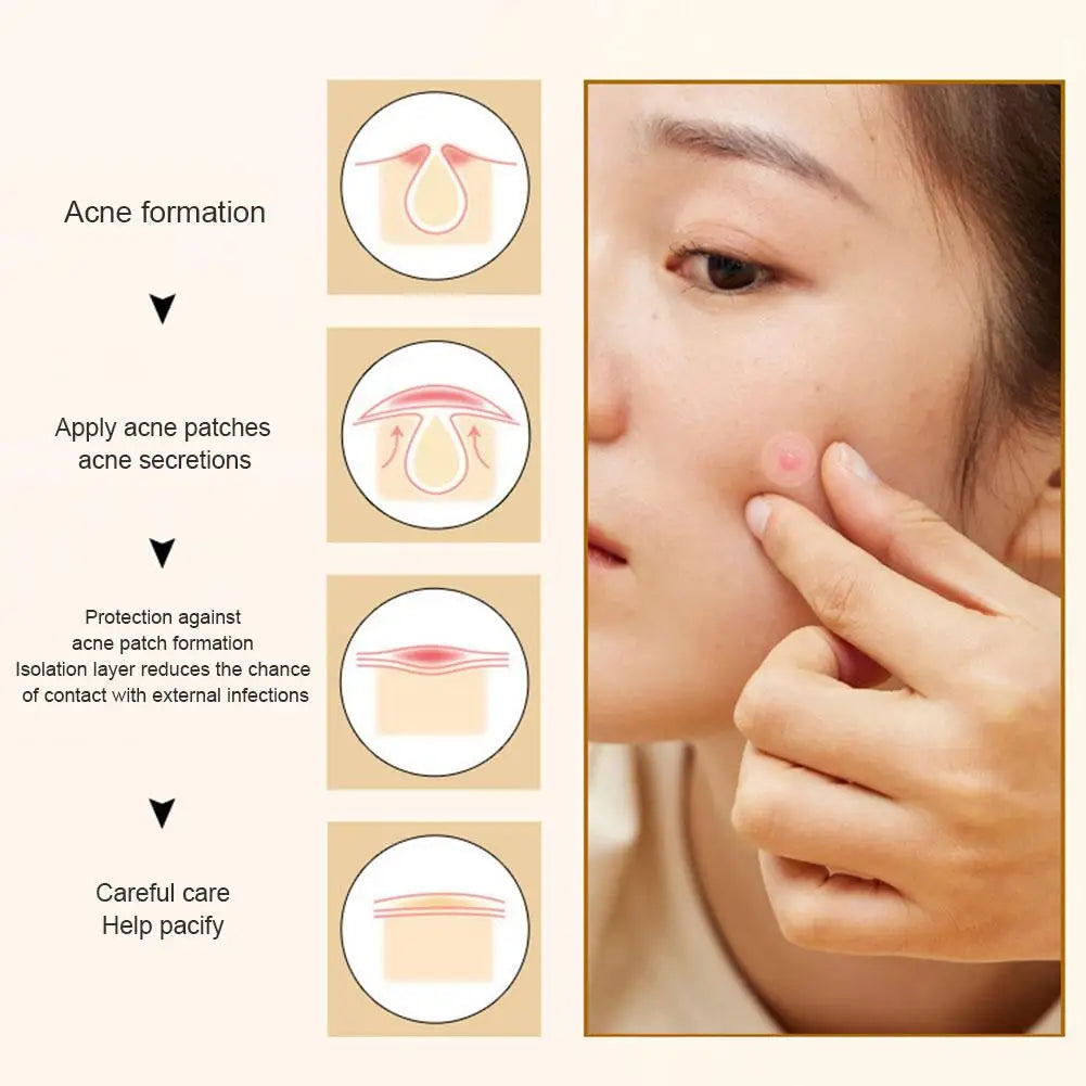 Cute "Pimple Patch" Acne Concealer Face Spot Scar Care Stickers